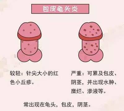 包皮浮肿是怎么回事