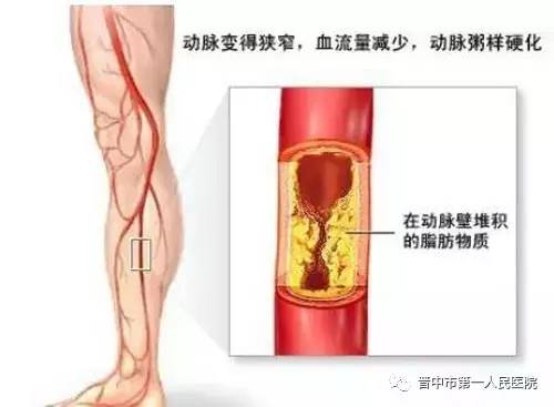 动脉闭塞怎么治疗