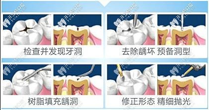 补牙整套多少钱