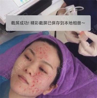 菲洛嘉水光针功效有副作用吗