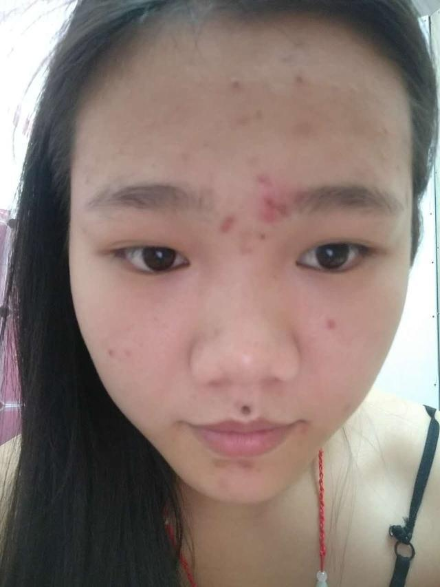 长痘痘的四个阶段