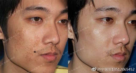 激光祛斑后反黑怎么办