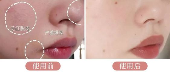 抢打痘痘