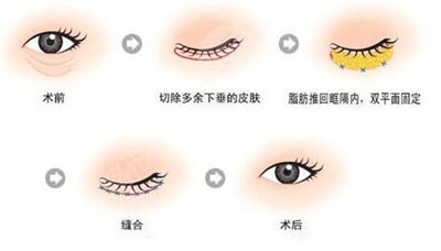 怎么治疗大眼袋
