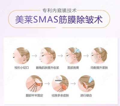 电波拉皮除皱术