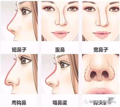线雕隆鼻和玻尿酸区别