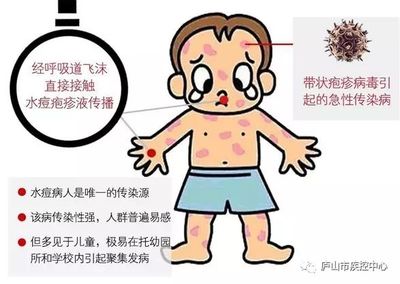 被别人传染了痘痘