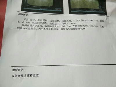 卵巢多囊样改变怎么治疗