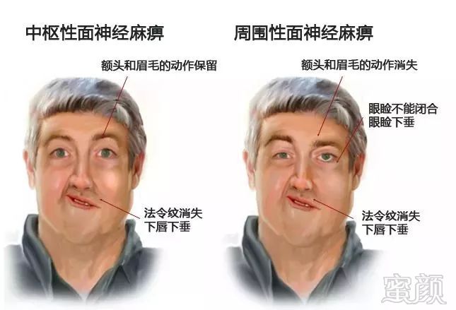 脸部麻是怎么回事