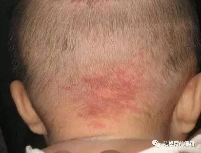 新生儿皮脂腺痣图片
