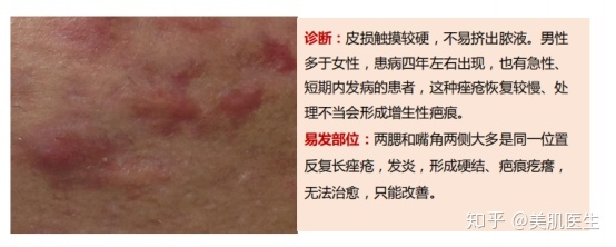 痤疮粉刺最有效的药