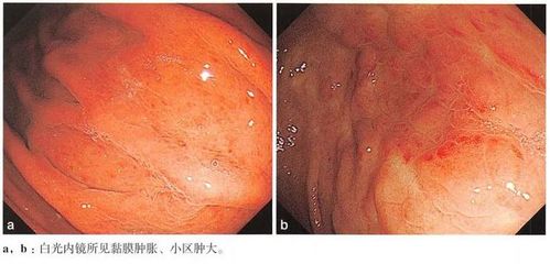 胃底腺增生怎么治疗