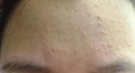 脸颊两侧毛孔越来越大