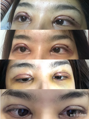 全切双眼皮照片