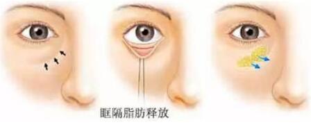 眼部脂肪填充
