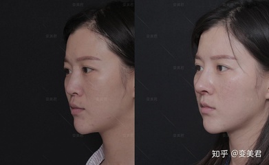 耳软骨隆鼻容易歪吗