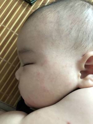 喝奶粉会长痘痘吗