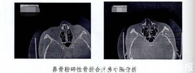 鼻骨骨折赔偿