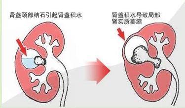 宝宝肾结石有什么症状