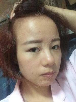 头部后面长痘痘是什么原因