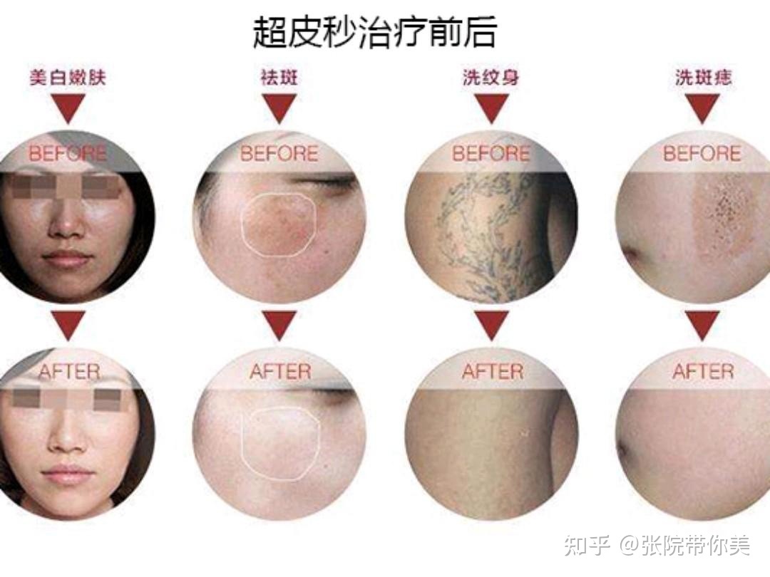 遗传斑怎么治疗
