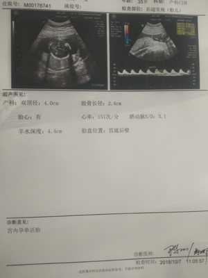 怀孕四个月怎么看男女