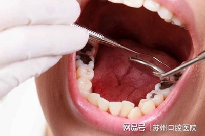 牙疼根管治疗是怎么治疗的
