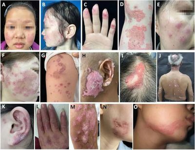 线状疣怎么治疗