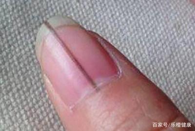 指甲有横纹是怎么回事