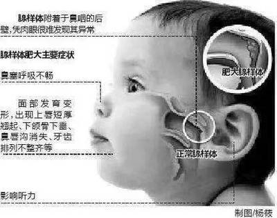 宝宝腺体肥大