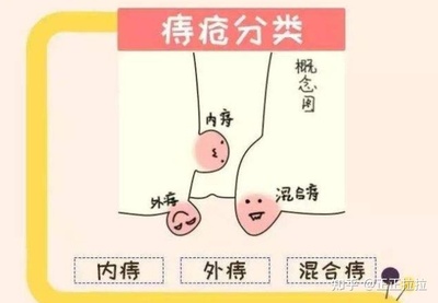 内痔外痔怎么治疗