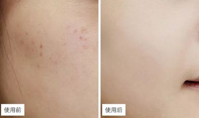 痘痘到多大年龄能消