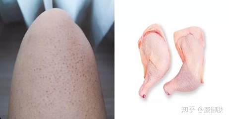 腿上毛孔发红