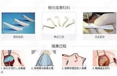 假体隆鼻恢复过程