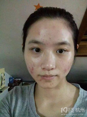 满脸痘痘用什么好