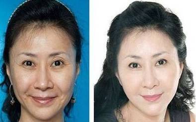 玻尿酸除皱效果能维持多久