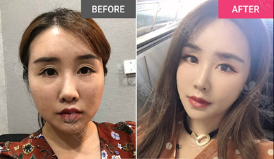 隆鼻整形效果