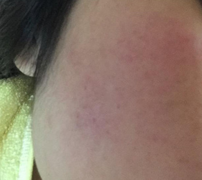痘痘留下疤痕怎么办