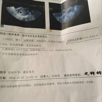 怀孕多久可见孕囊