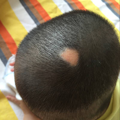 新生儿皮脂腺痣图片