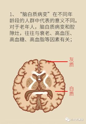 脑梗是怎么回事