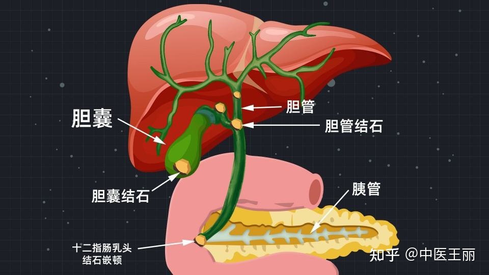 胆管结石怎么治疗