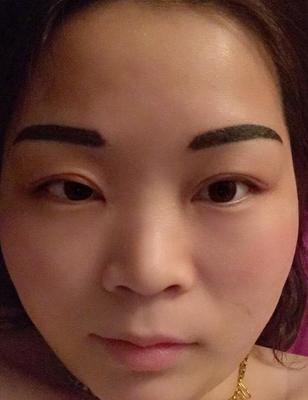 双眼皮抽线怎么抽