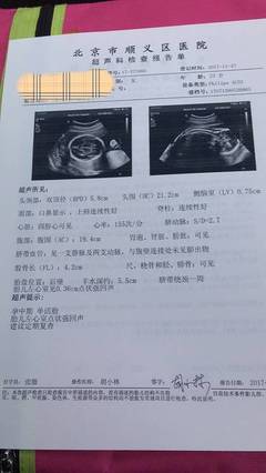 胎儿在左边