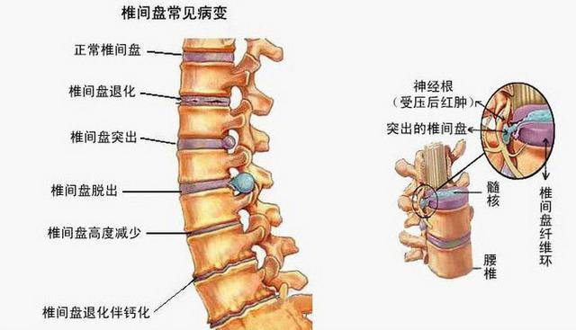 腰间盘突出压迫神经怎么治疗