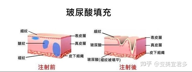 舒颜玻尿酸是大分子吗