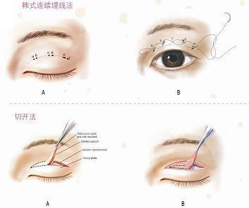 双眼皮切割术