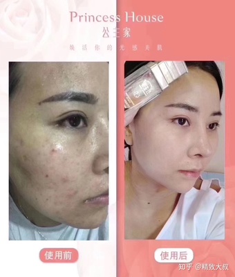 痘痘男護膚哪個好