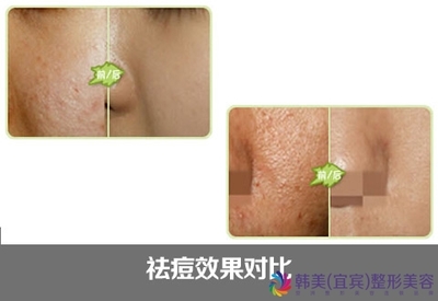 激光治疗痘痘需要注意什么