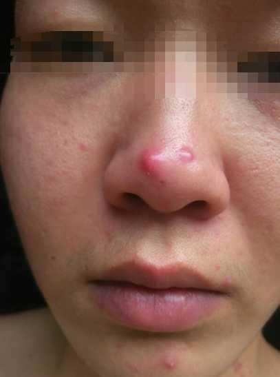 脑门下巴鼻子周围长痘痘